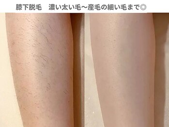 ピュアノア 三木店/腕|全身脱毛　三木|小野|西脇