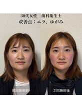 ザ リフト カドモリ 鹿児島 霧島(The Lift KADOMORI)/30代女性/エラ張り、歪み