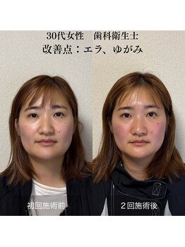 ザ リフト カドモリ 鹿児島 霧島(The Lift KADOMORI)/30代女性/エラ張り、歪み