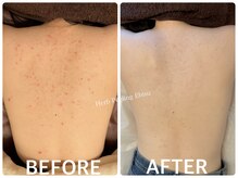 ハーブピーリング 恵比寿/背中ニキビ/引締め