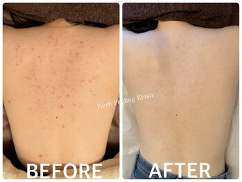 ハーブピーリング 恵比寿/背中ニキビ/引締め