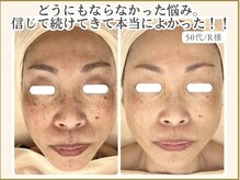 ポモナ 横浜馬車道店(Pomona)/シミ改善と、か◯ぱんが悩みの方