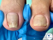 プラスワンフット 本厚木(+1 Foot)/巻き爪矯正は専門店へ●