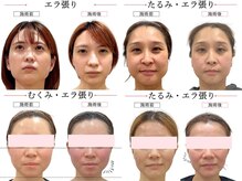 グレースエール トータルビューティーサロン(Grace Aile)の雰囲気（【 エラ張り・たるみ・むくみ 】）