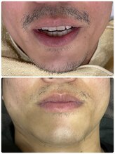 ギャラクシービューティー(galaxy beauty)/ヒゲのW脱毛