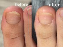 爪のいろは/放っておくと変形爪になるかも…