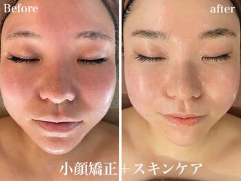 オレアグリーン 岡崎(OLEA green)/小顔矯正1年後(エステ/シミケア)