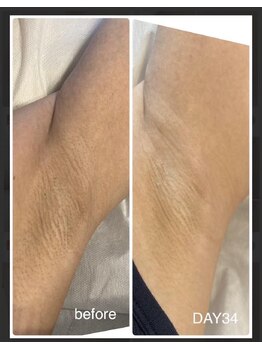 ファースト(1st)/ローマピンク【脇・ワキ】