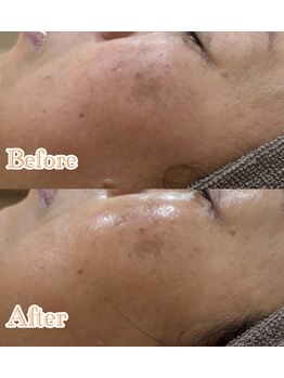 リラ 郡山店(Lilas)/シミ、くすみにアプローチ☆