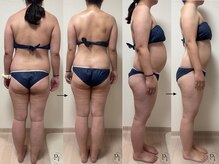 プラスワンビューティテン 新大阪店(Plus One Beauty)/ボディ/ハイパーナイフ/痩身