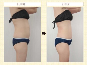 エステアンドトレーニング ビビ(ViVi)/お腹