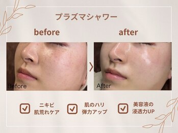 シロ(CHILO)/プラズマシャワー
