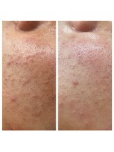 トータルビューティーサロン ナーズ(NAZ)/ハイドロピーリング毛穴洗浄