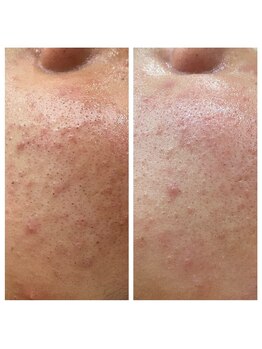 トータルビューティーサロン ナーズ(NAZ)/ハイドロピーリング毛穴洗浄