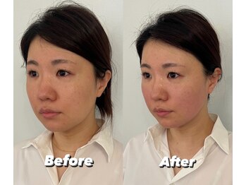 コルミチョン サロン(骨美整 salon)/Before・After 1回施術