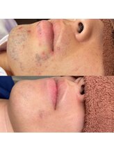 プルメリア(Plumeria)/髭脱毛でのお肌の変化☆