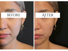 クク 赤坂 天神(99 KUKU)/【ほうれい線】