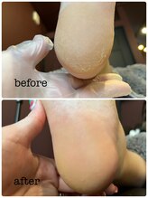 カラン(KARAN)/カサカサかかと