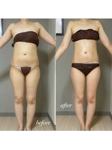 エヌボーテ(N. beaute)/before→after２回目