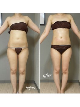 エヌボーテ(N. beaute)/before→after2回目