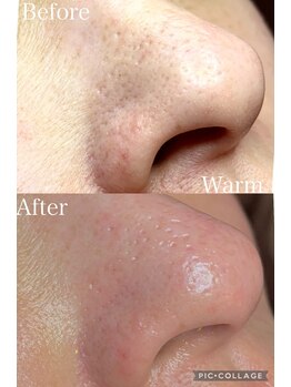 ウォーム(Warm)/40代女性毛穴エクストラクション