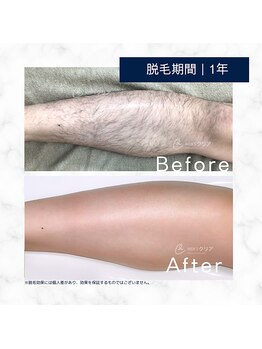 メンズクリア いわき店/【メンズクリア】お客様の施術例