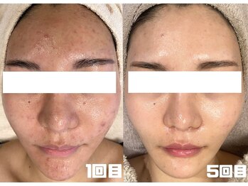 モーヴ(MAUVE)/陶肌トリートメント