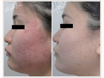 ミューベル(MYubelle)/ニキビ毛穴ケア 水光ピーリング