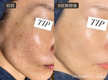 ジュパール(je pars)/シミ専用ハーブピーリング