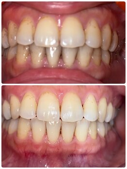 コントレール 歯ぁと(CONTRAIL)/ビフォーアフター