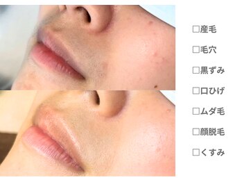 ピュアノア 垂水店/産毛脱毛　顔脱毛　神戸垂水明石