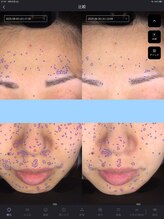 ウニ(uni)/オーダーメイド肌管理の症例です