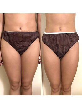 シーアイエステティック 船橋駅前店(c.iエステティック)/EMS 120分&レモンボトル