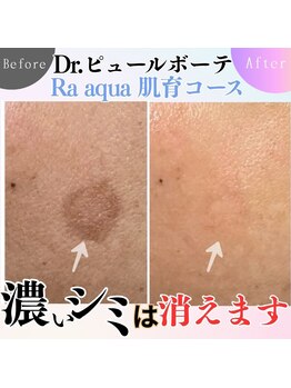 エステティックサロン ラ アクア(ra aqua)/その”濃いシミ”変われます!