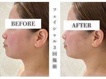 リアレント 高槻店(Lialent)の雰囲気（疲れ顔卒業！たるみ・小顔・艶肌にはインディバフェイシャル♪）