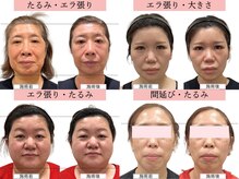 グレースエール トータルビューティーサロン(Grace Aile)の雰囲気（【 たるみ・ほうれい線・ゆがみ 】）