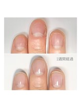 リモネイル(Rimo nail)/深爪改善・深爪矯正