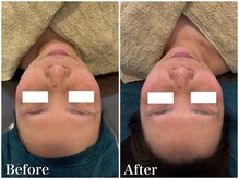 サロンドフェイス(Salon de Faith)/【コルギ+小顔パック】1回施術♪