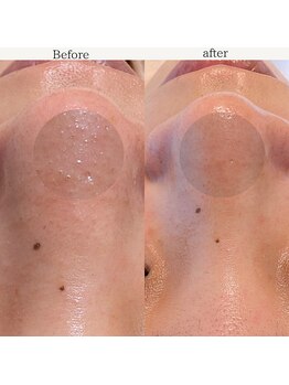 エミナル バイ ニコドット(Eminal by nico.)/角栓・角質のケア1回目のケア後