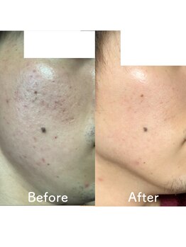 ウル(ulu)/無針水光注入