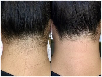 カルム(Calme)/うなじ脱毛