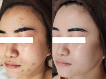 ビーピー 渋谷(b.p.)の雰囲気（ニキビケア、ハーブピーリング、肌質改善　　渋谷）