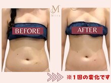 ミラ 札幌店(Mira)/結果が出るW施術/ハイパーナイフ