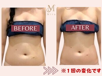 ミラ 札幌店(Mira)/結果が出るW施術/ハイパーナイフ