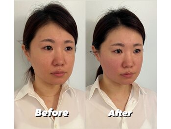 コルミチョン サロン(骨美整 salon)/Before・After 1回施術
