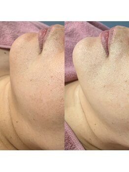 ビューティーワンド ココ(Beauty Wand COCO)/