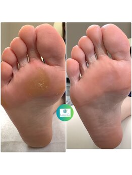 リゼラアンドコー たまプラーザ店/フットキュアコース