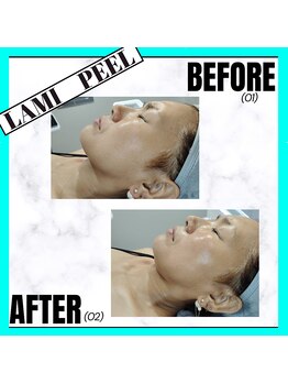 グランディールアン(GRANDIR UN)/ラミピールbefore－after