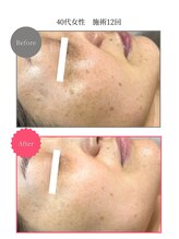 ボータン 恵(Beau Temps)/ウルトラ光トーニング/シミ改善