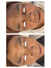 ワッカ(wacca)/【ヒト幹細胞】ビフォーアフター